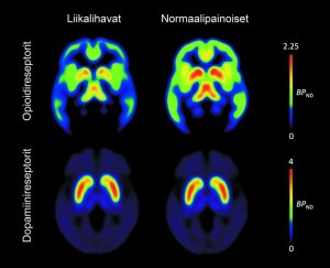 Obesity is associated with brain’s neurotransmitters