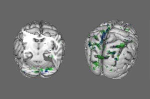 People with anorexia, body dysmorphic disorder have similar brain anomalies