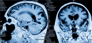 Key differences in brain activity in people with anorexia nervosa revealed by study